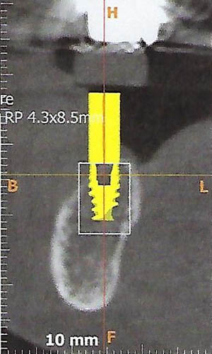 carestream 9300 digital x rays